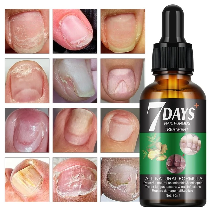 7 Days Nail Fungus Treatment Serum